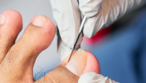 ingrown toenail removal doctor